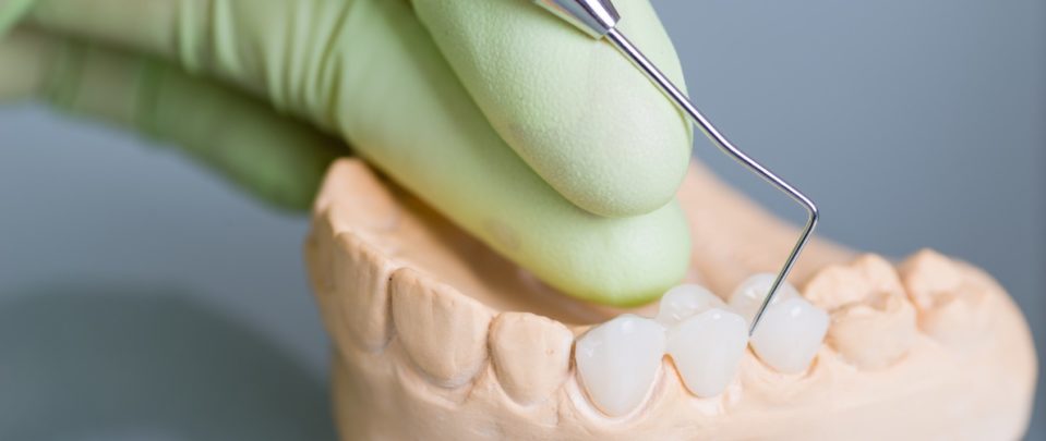 Hand of dentist holding dental gypsum models